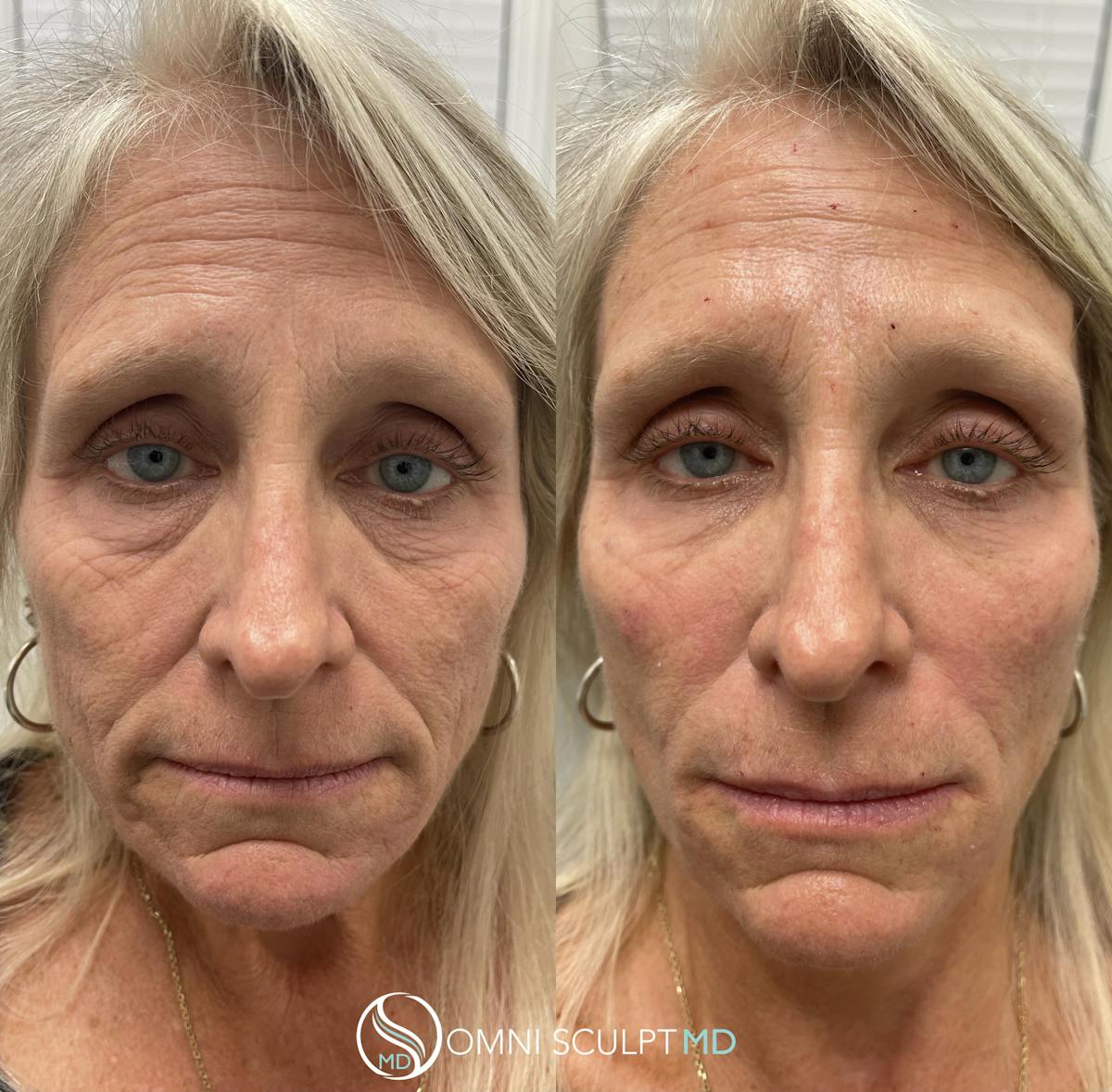 Jawline Chin Filler Before & After Gallery - Patient 183947 - Image 1