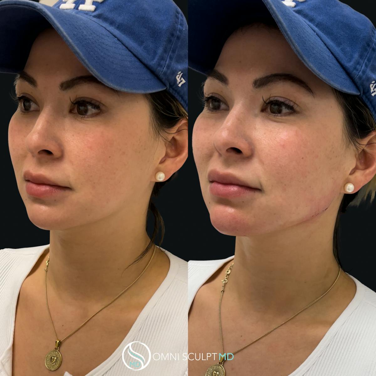 Jawline Chin Filler Before & After Gallery - Patient 428283 - Image 1