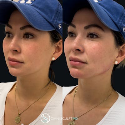 Jawline Chin Filler Before & After Gallery - Patient 428283 - Image 1