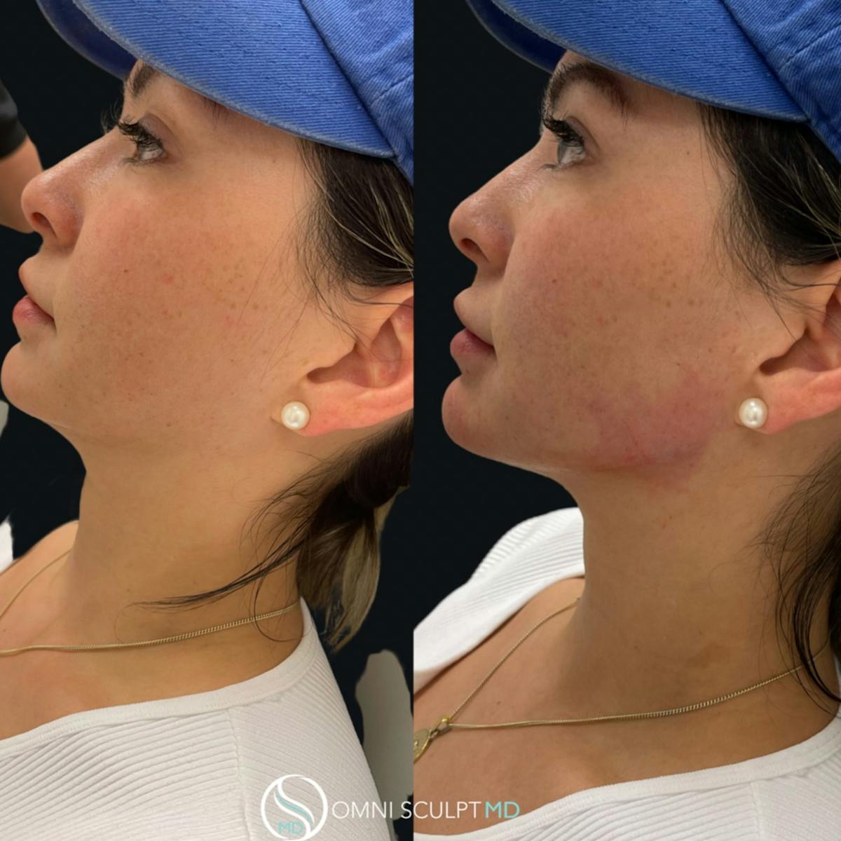 Jawline Chin Filler Before & After Gallery - Patient 428283 - Image 2