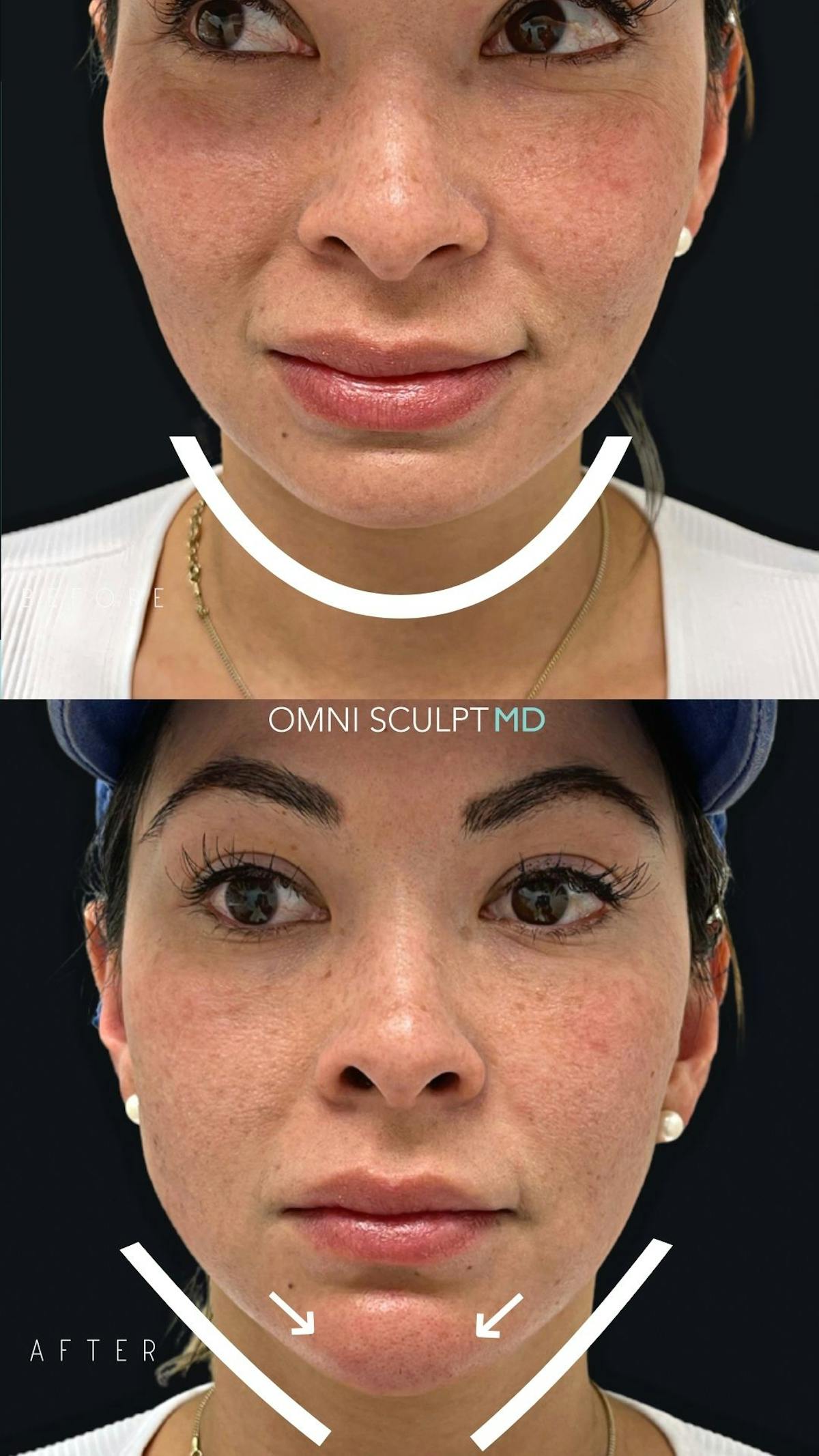 Jawline Chin Filler Before & After Gallery - Patient 428283 - Image 3