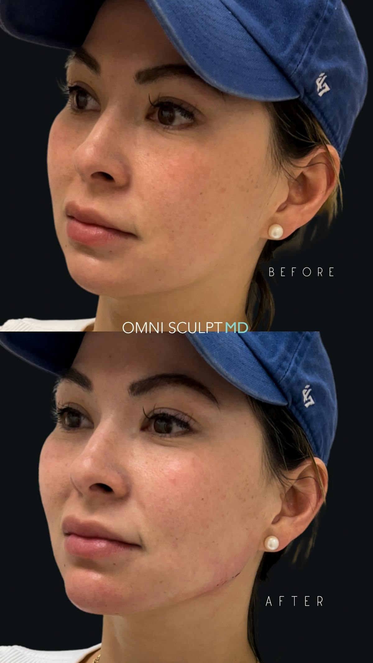 Jawline Chin Filler Before & After Gallery - Patient 428283 - Image 4