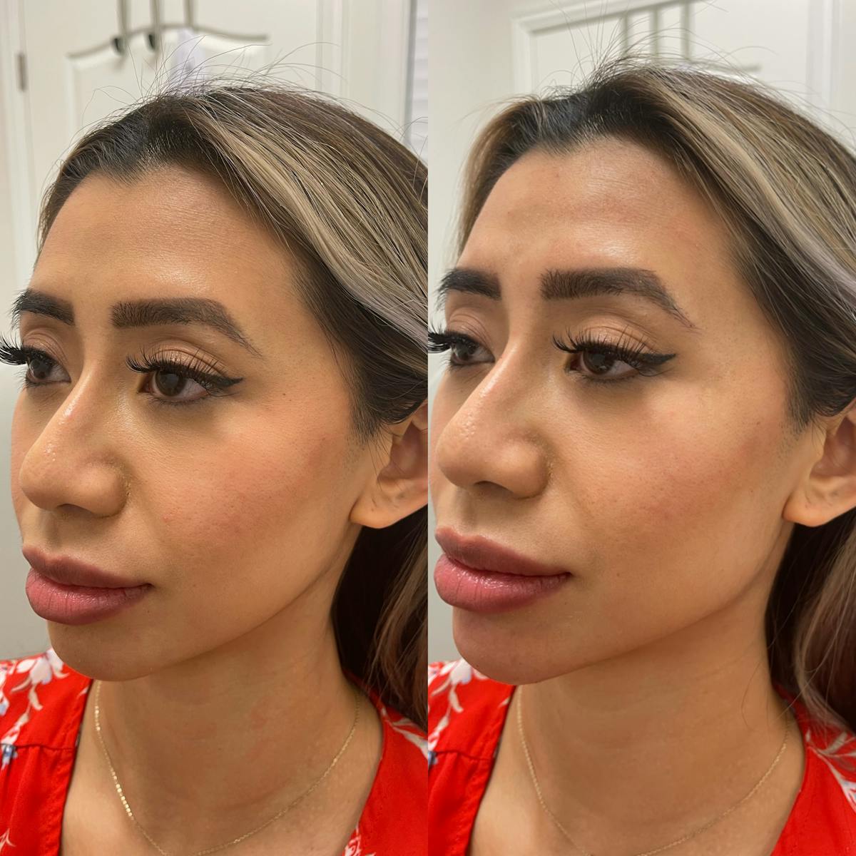 Jawline Chin Filler Before & After Gallery - Patient 135764 - Image 1