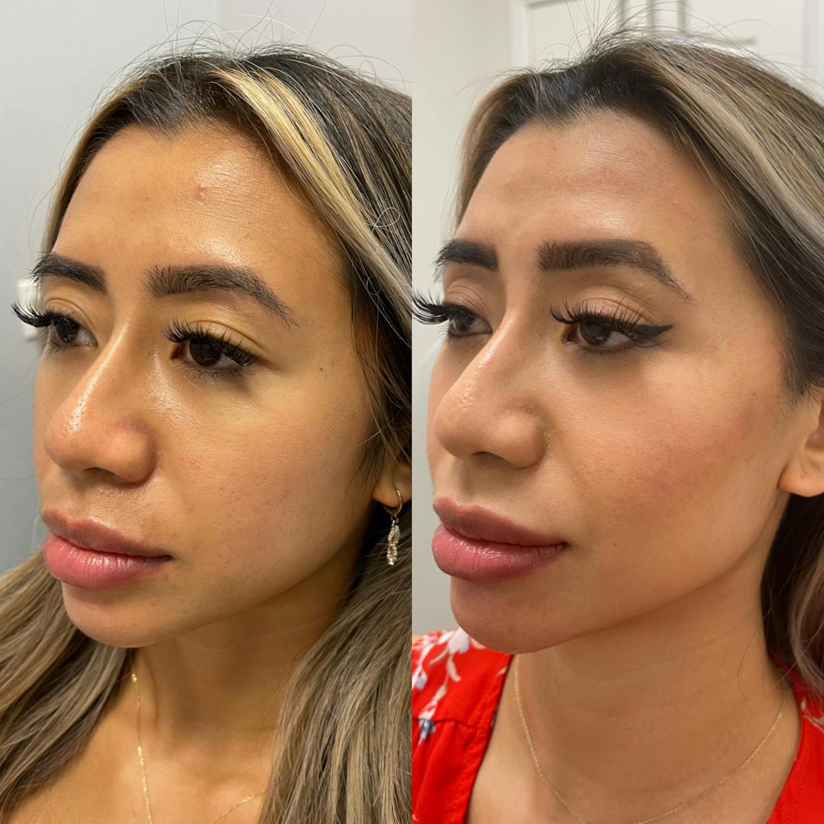 Jawline Chin Filler Before & After Gallery - Patient 135764 - Image 2