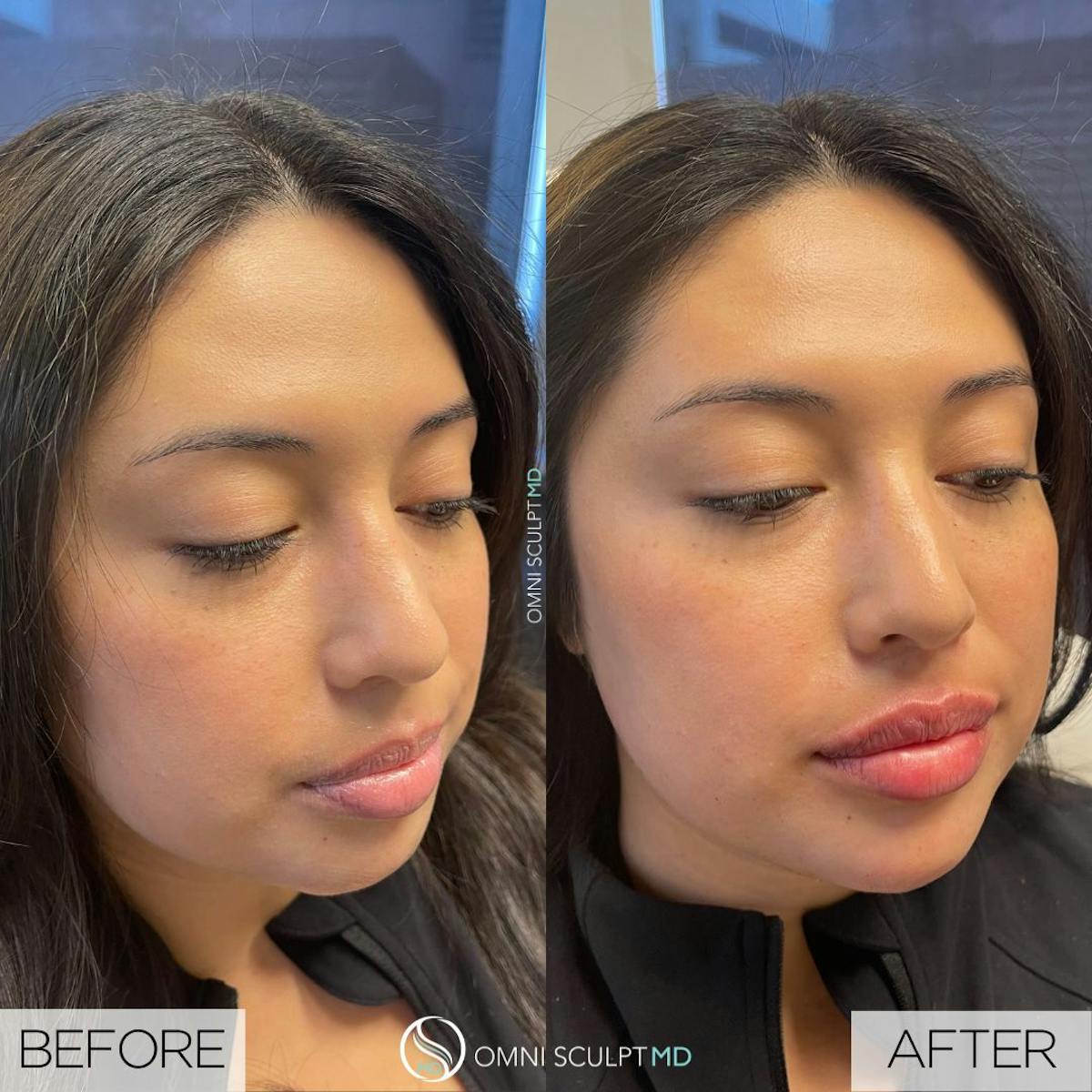 Jawline Chin Filler Before & After Gallery - Patient 411854 - Image 1