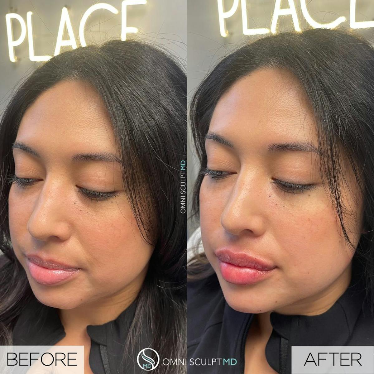 Jawline Chin Filler Before & After Gallery - Patient 411854 - Image 3