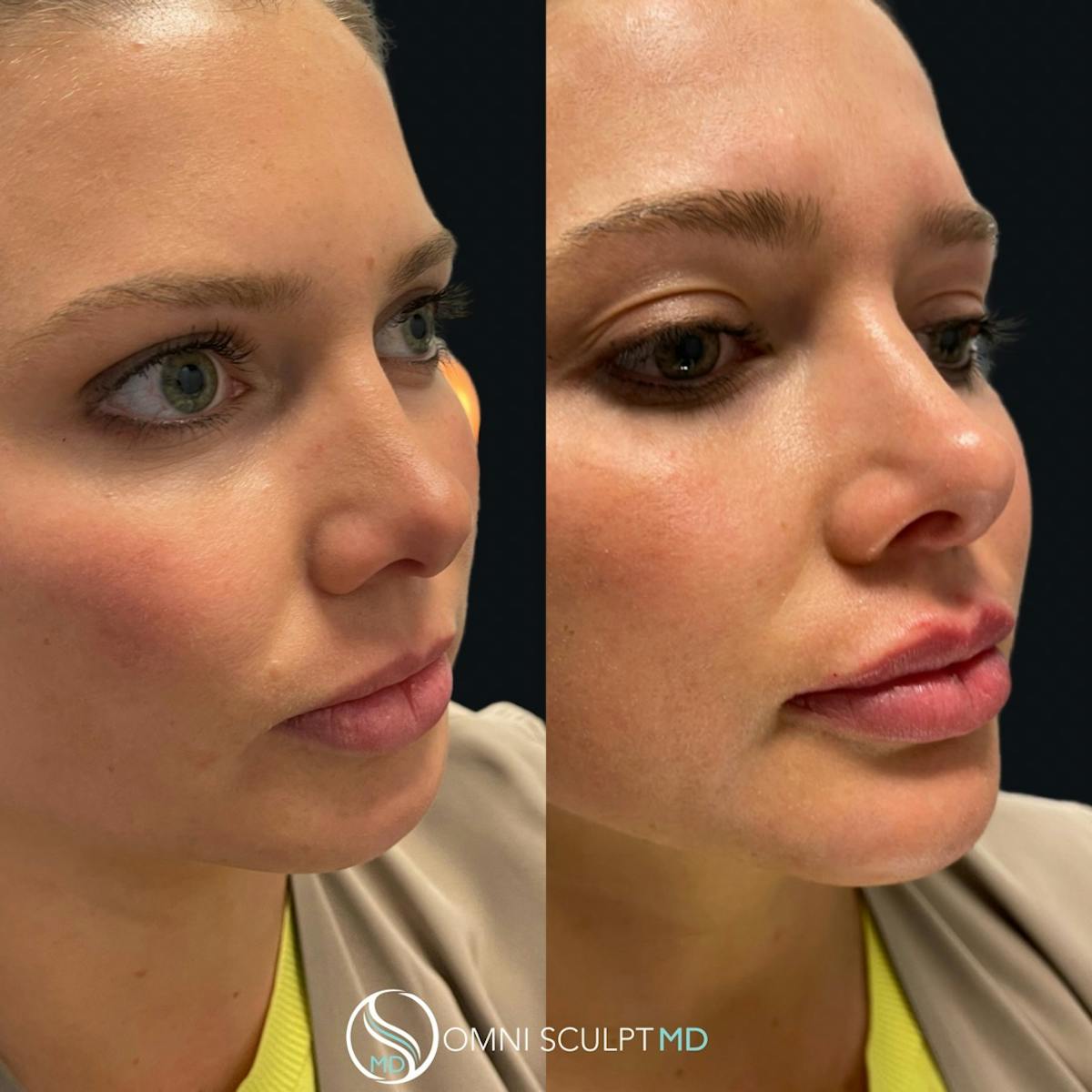 Jawline Chin Filler Before & After Gallery - Patient 391805 - Image 1