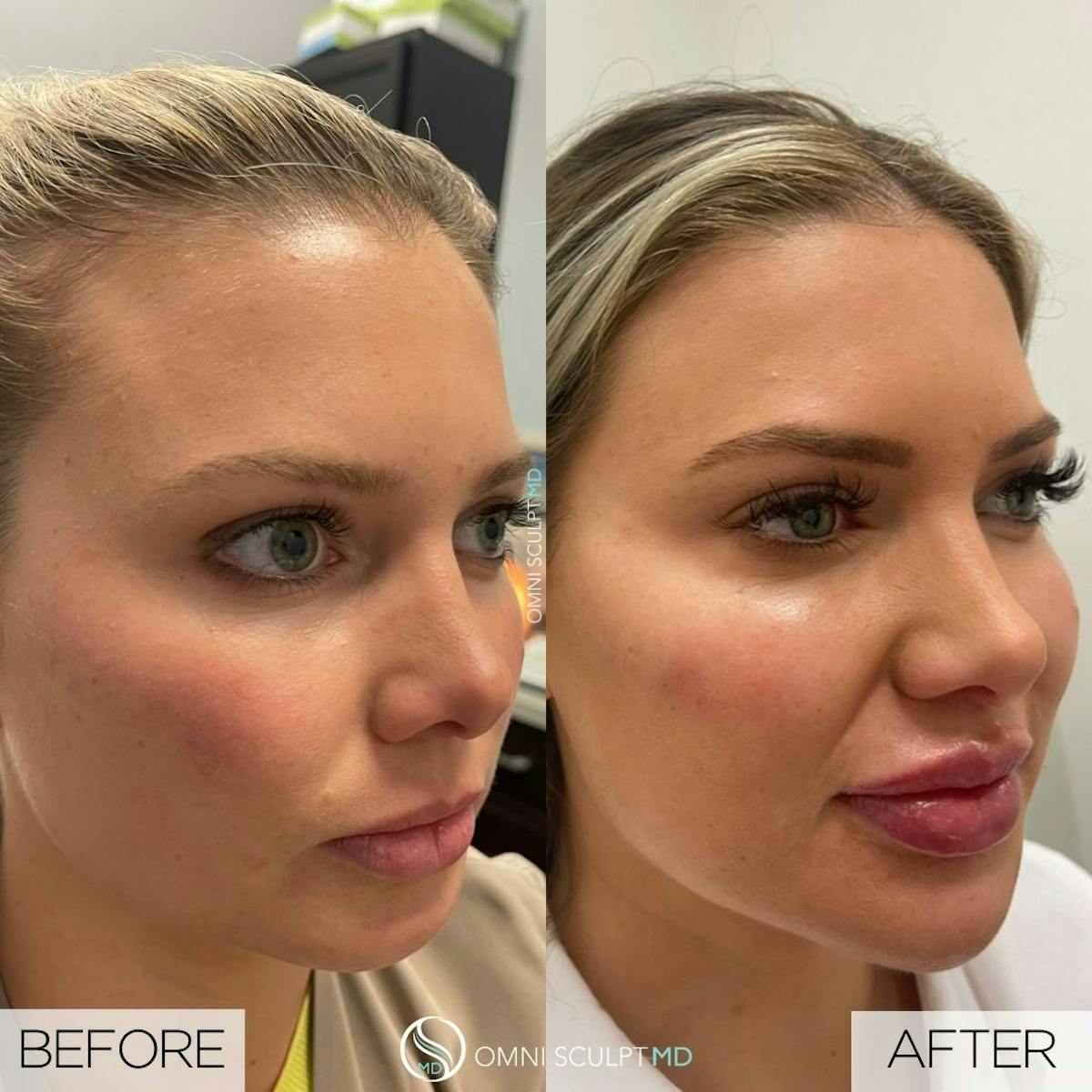 Jawline Chin Filler Before & After Gallery - Patient 391805 - Image 2