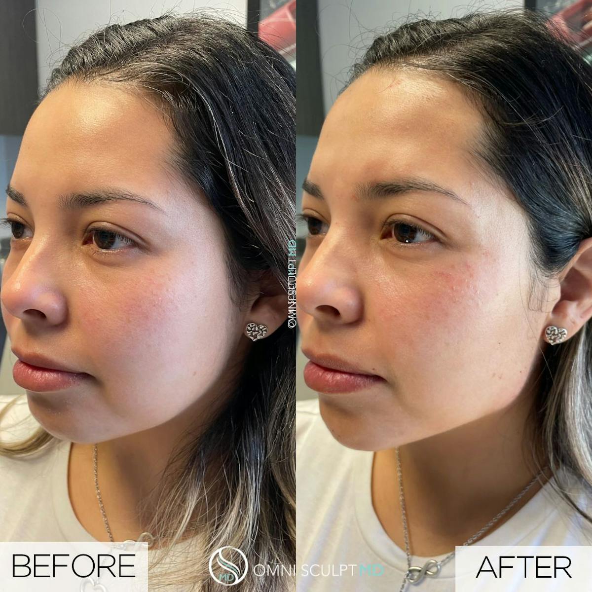 Jawline Chin Filler Before & After Gallery - Patient 213550 - Image 1