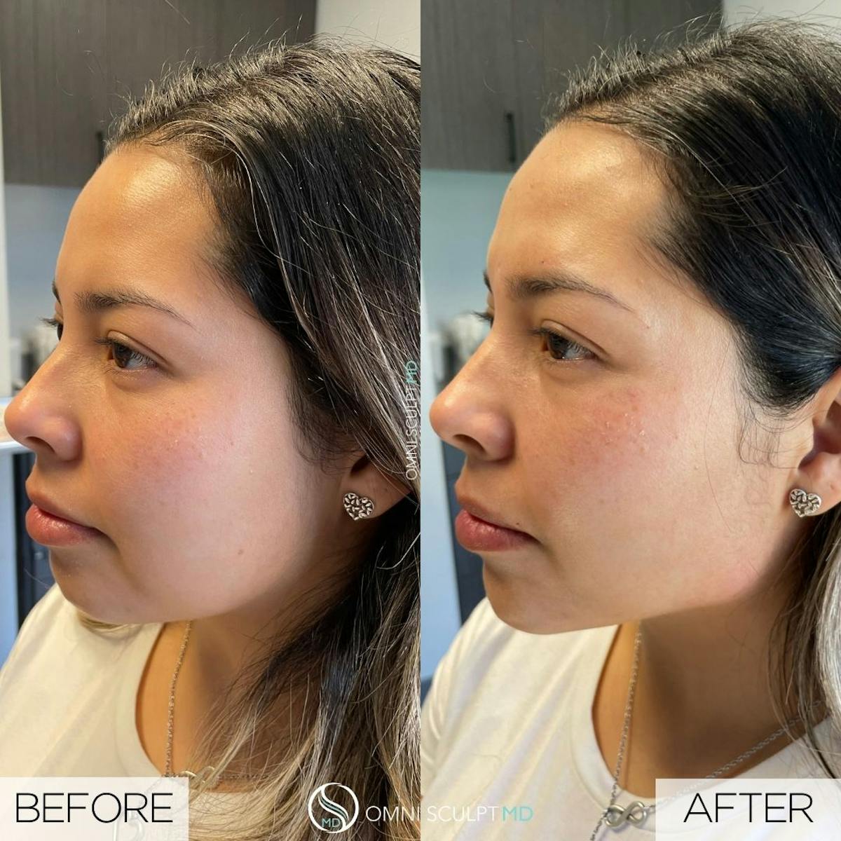 Jawline Chin Filler Before & After Gallery - Patient 213550 - Image 2
