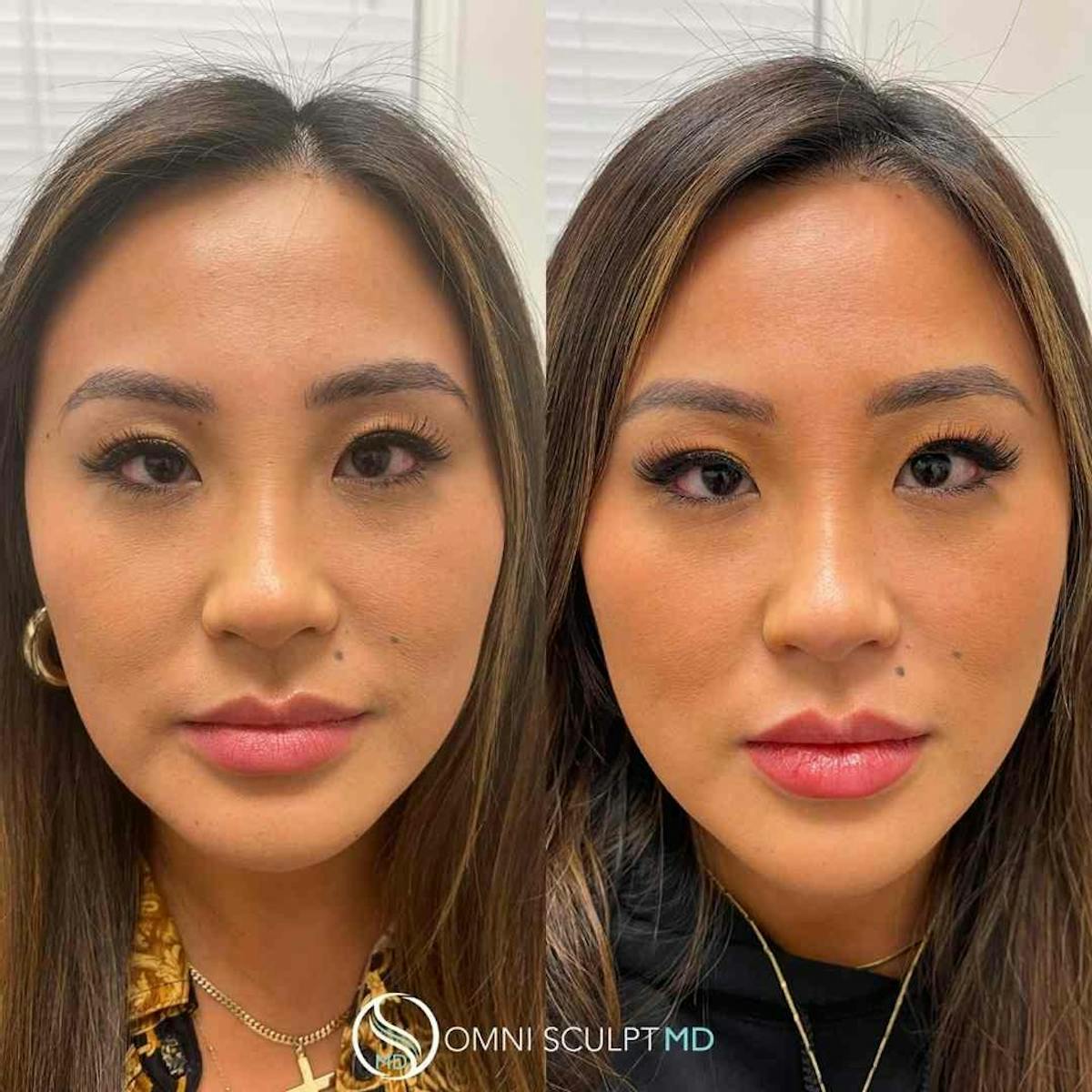 Jawline Chin Filler Before & After Gallery - Patient 258666 - Image 1