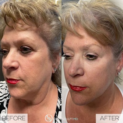 Jawline Chin Filler Before & After Gallery - Patient 143451 - Image 1