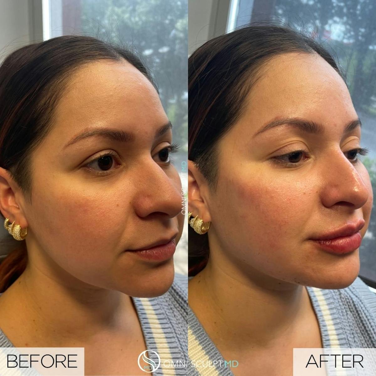 Jawline Chin Filler Before & After Gallery - Patient 399440 - Image 1