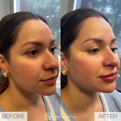 Jawline Chin Filler Before & After Gallery - Patient 399440 - Image 1