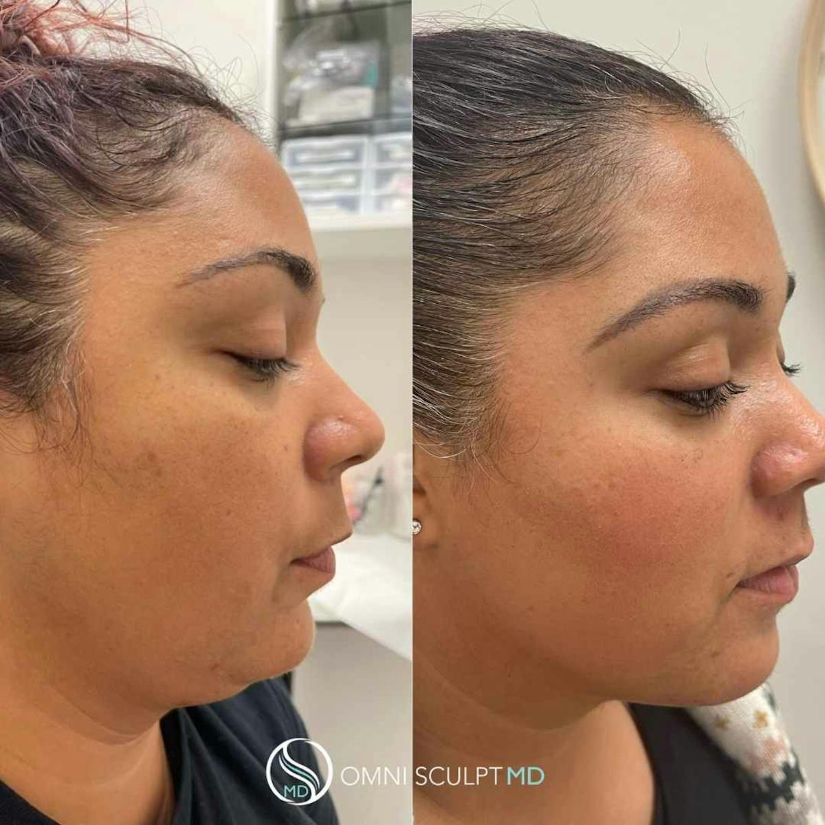 Kybella Before & After Gallery - Patient 118697 - Image 1