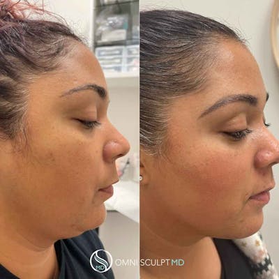 Kybella Before & After Gallery - Patient 118697 - Image 1