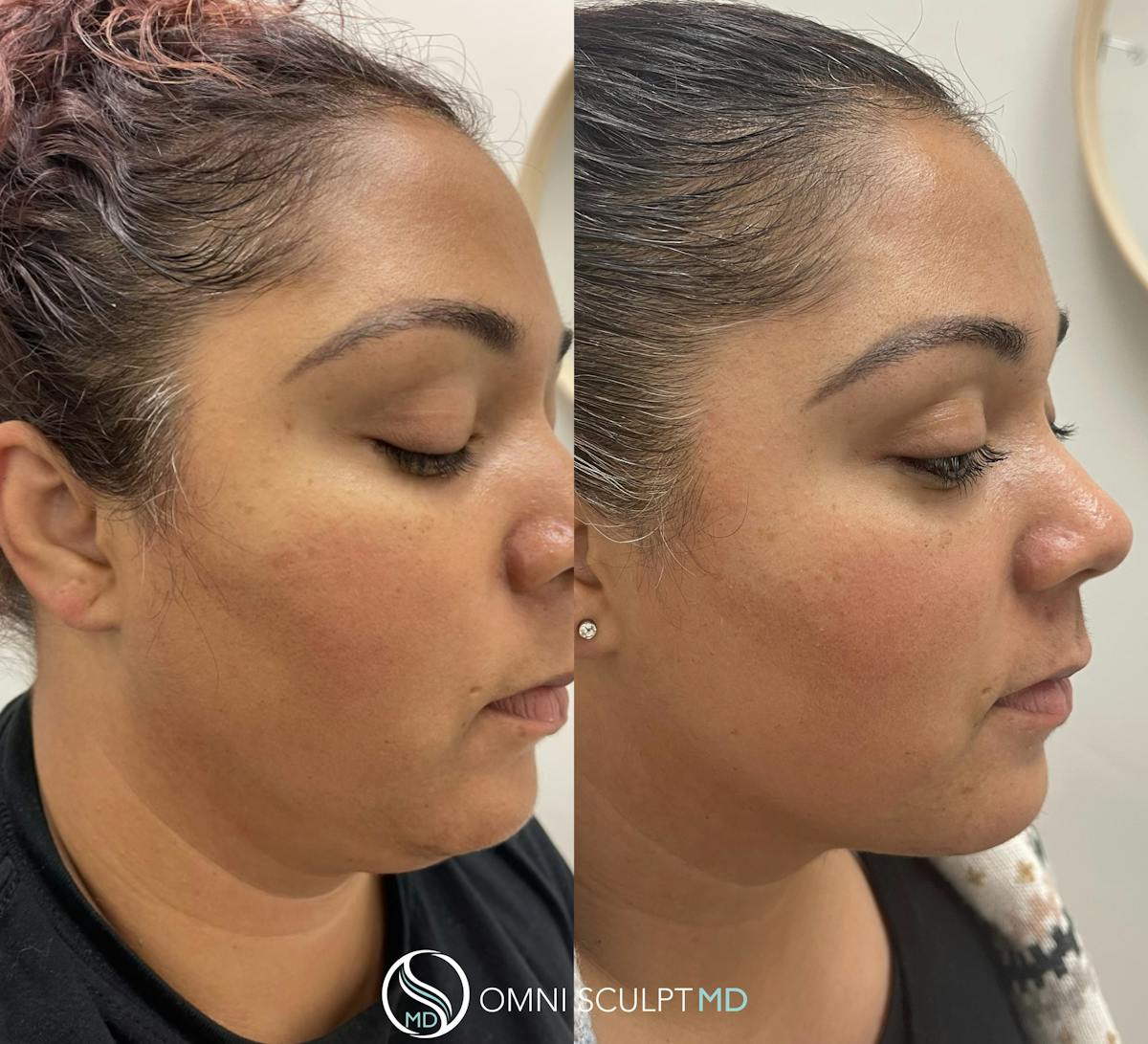 Kybella Before & After Gallery - Patient 118697 - Image 2
