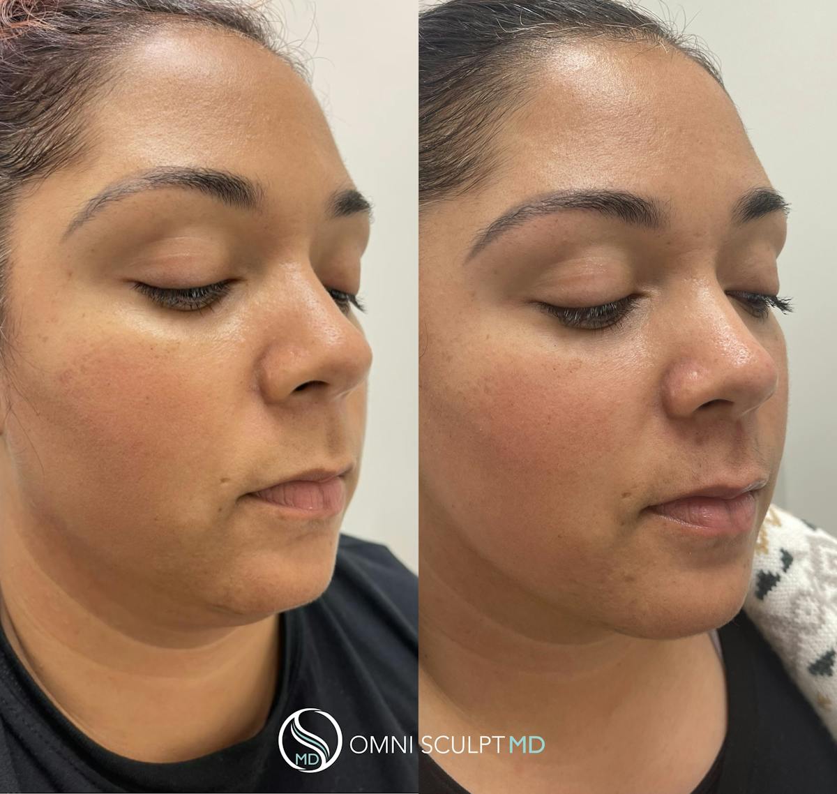 Kybella Before & After Gallery - Patient 118697 - Image 3