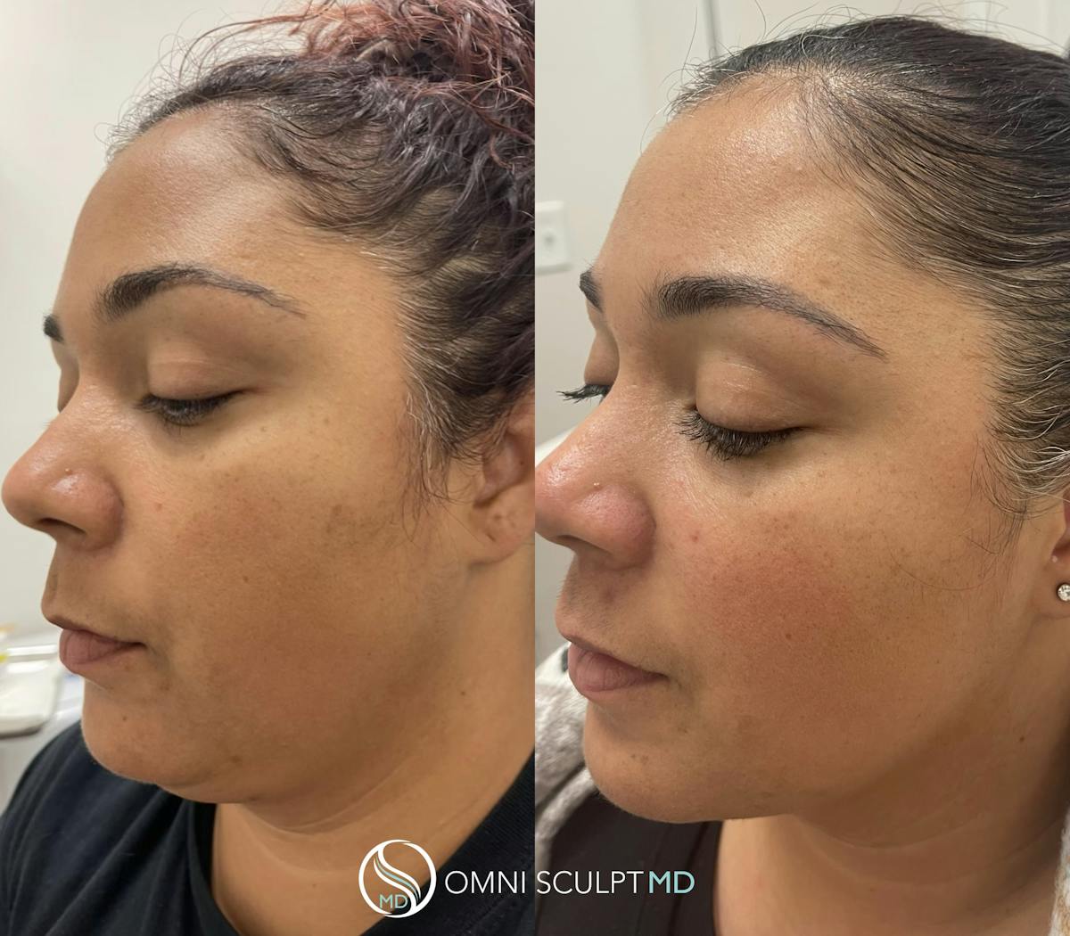 Kybella Before & After Gallery - Patient 118697 - Image 4