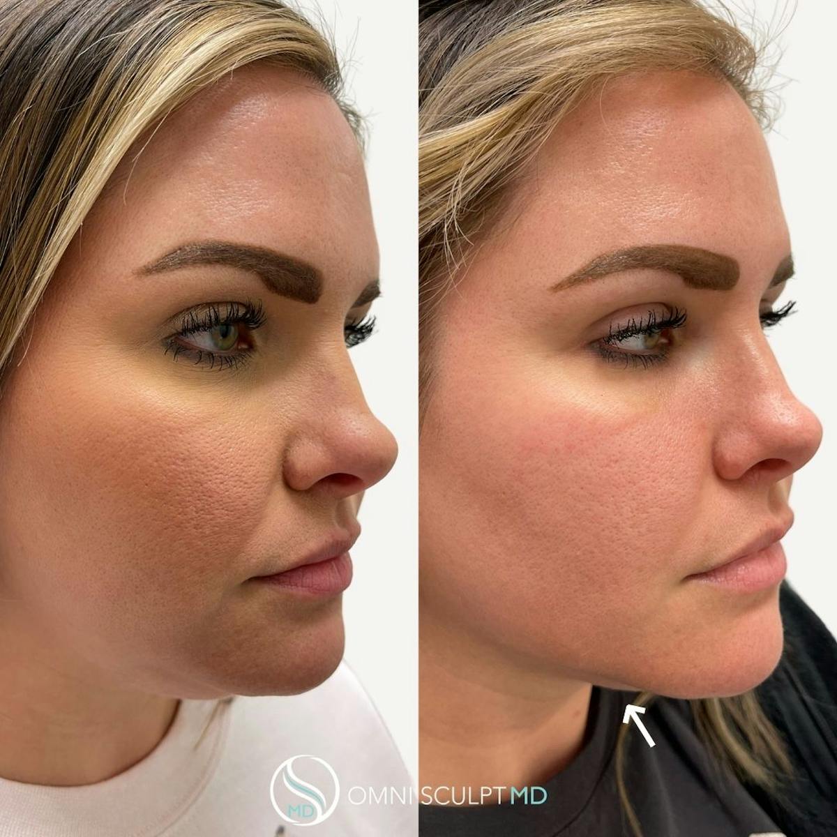 Kybella Before & After Gallery - Patient 276765 - Image 1