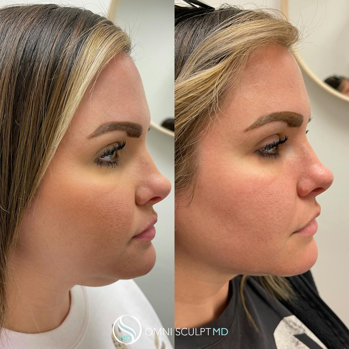 Kybella Before & After Gallery - Patient 276765 - Image 2