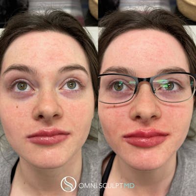 Lips Before & After Gallery - Patient 427422 - Image 1