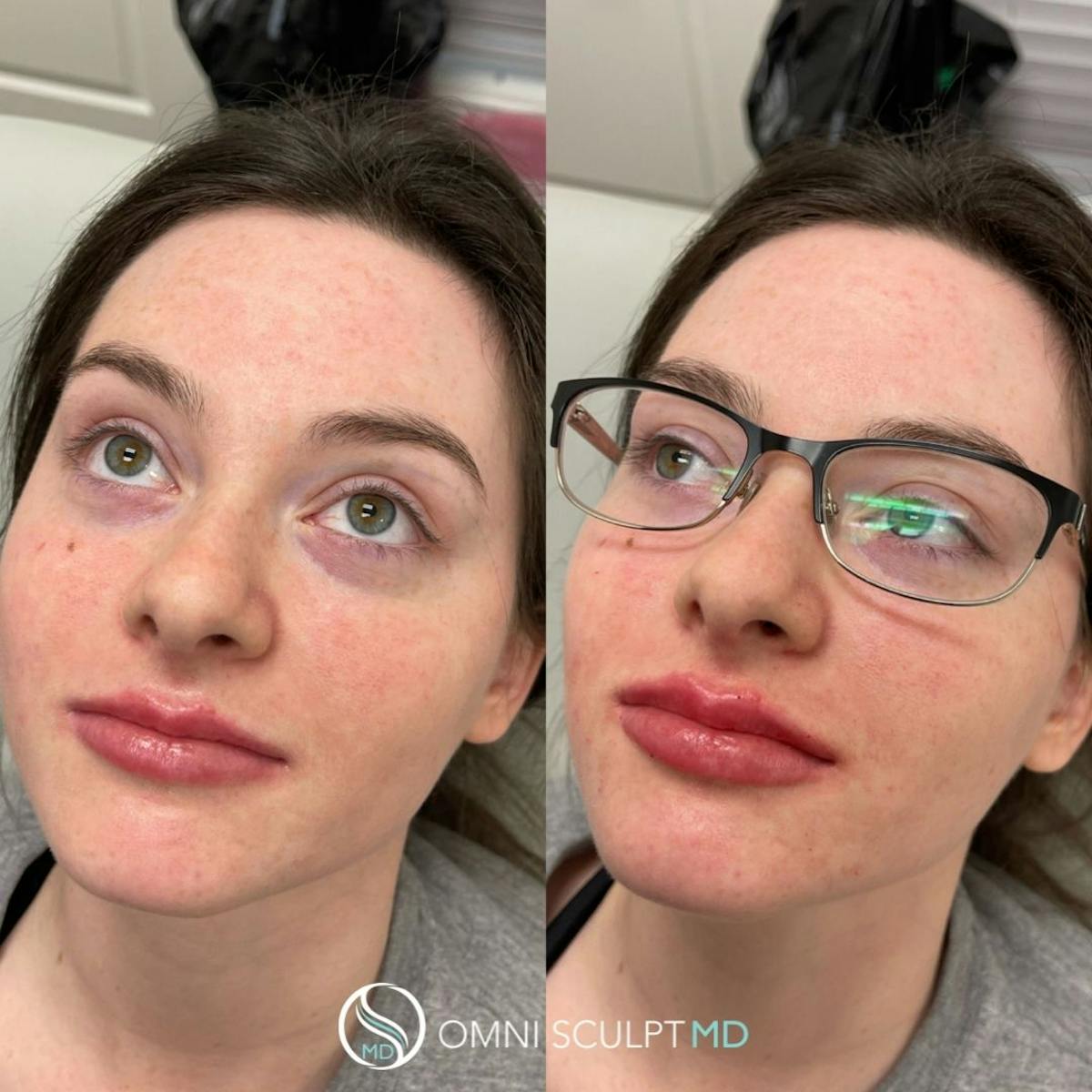 Lips Before & After Gallery - Patient 427422 - Image 2
