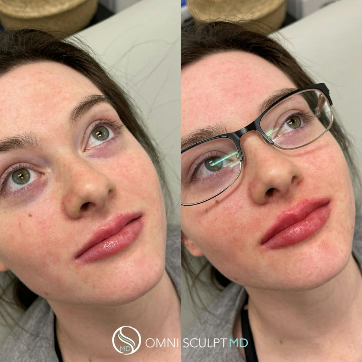Lips Before & After Gallery - Patient 427422 - Image 3