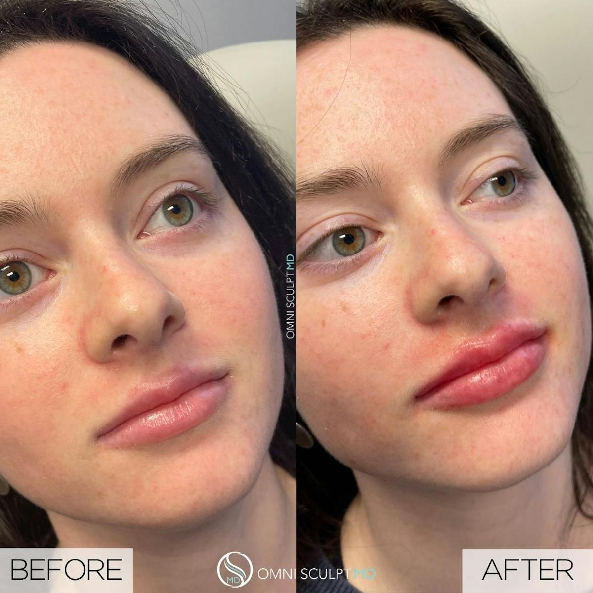Lips Before & After Gallery - Patient 427422 - Image 4