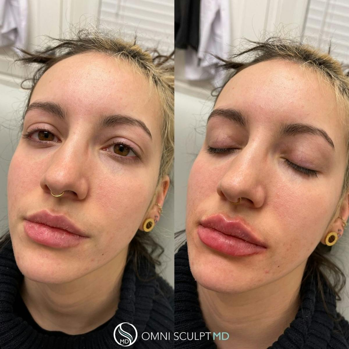 Lips Before & After Gallery - Patient 904141 - Image 1