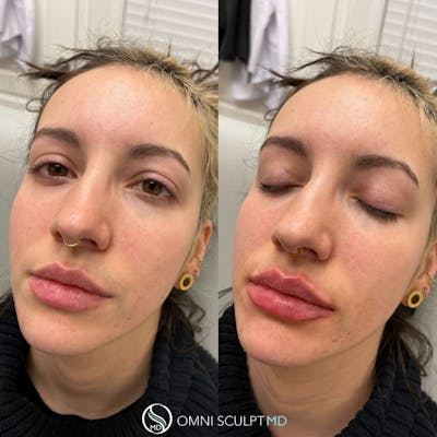 Lips Before & After Gallery - Patient 904141 - Image 1