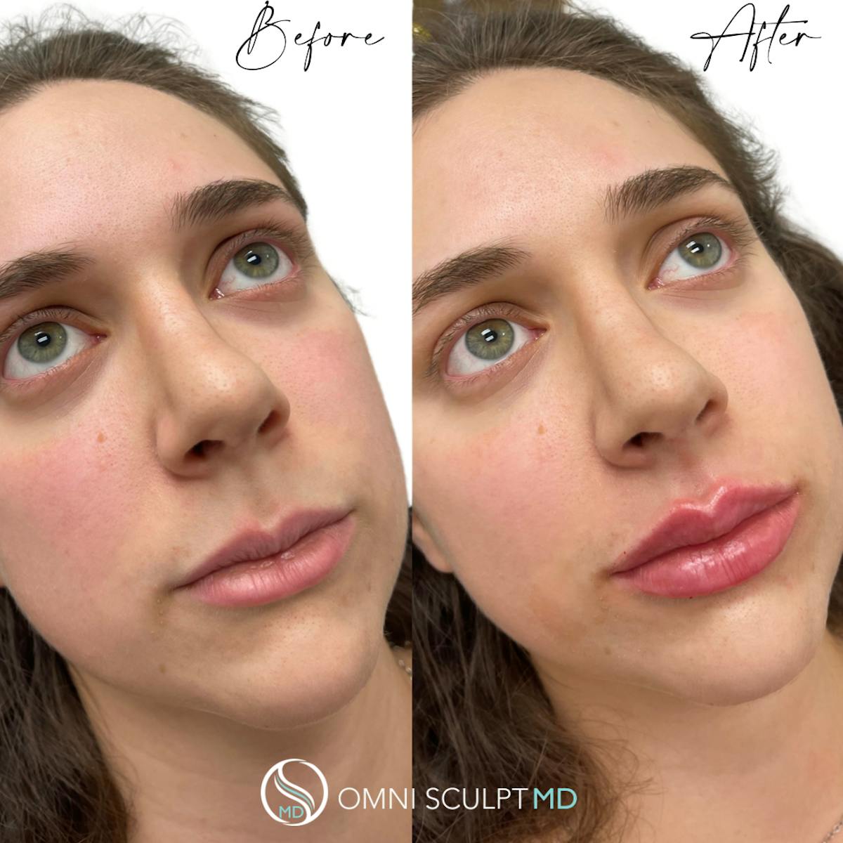 Lips Before & After Gallery - Patient 219680 - Image 1