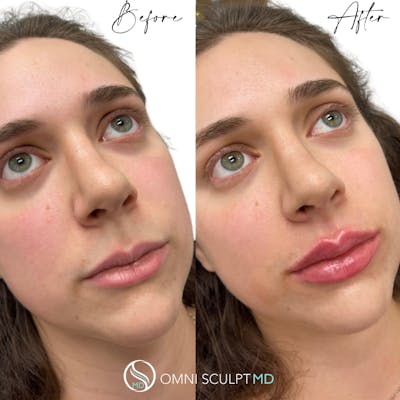 Lips Before & After Gallery - Patient 219680 - Image 1