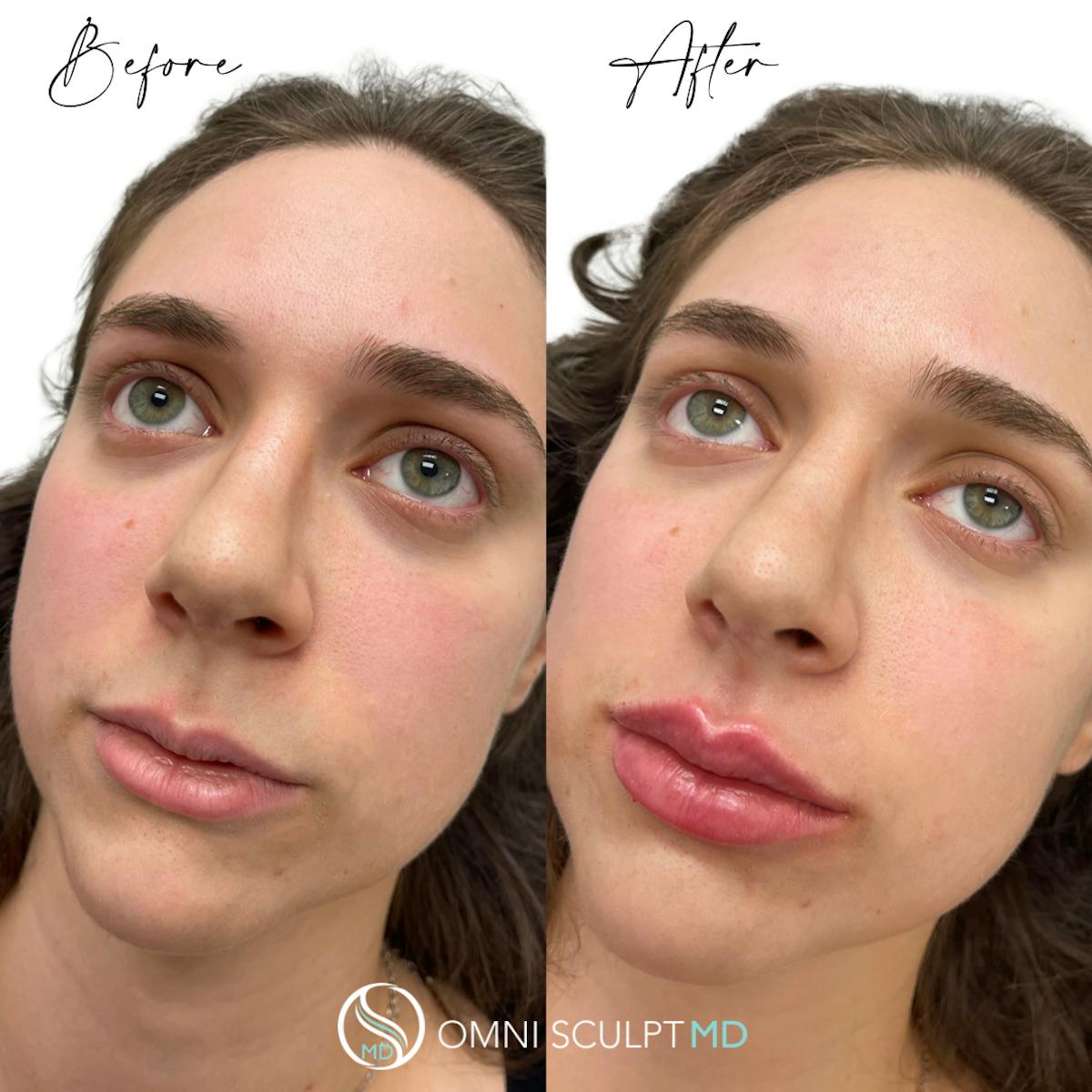 Lips Before & After Gallery - Patient 219680 - Image 2