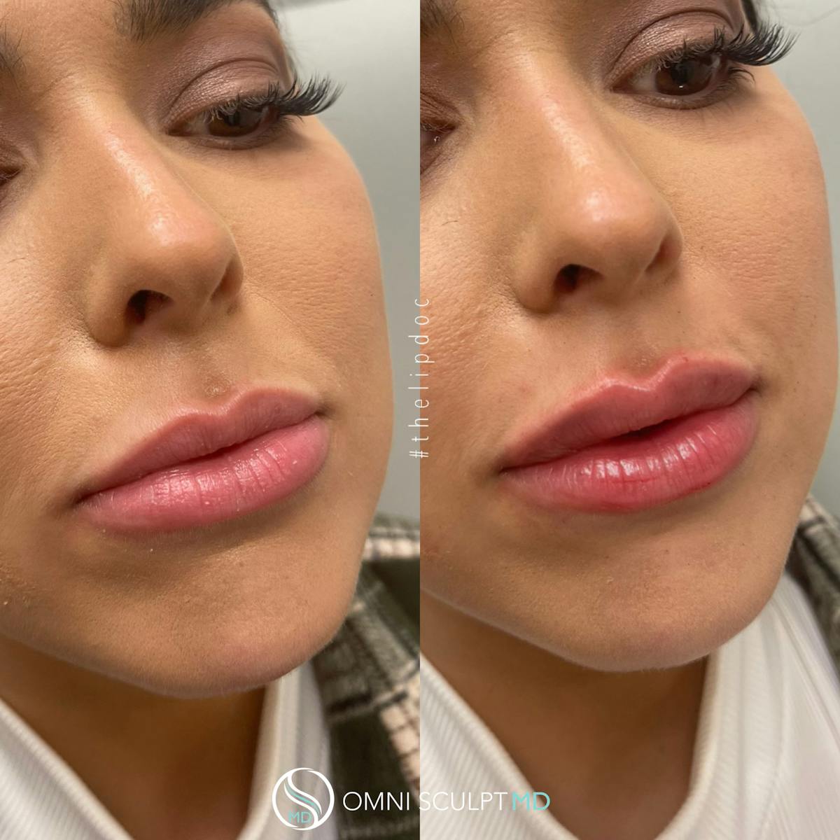 Lips Before & After Gallery - Patient 513655 - Image 1