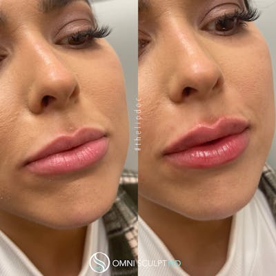 Lips Before & After Gallery - Patient 513655 - Image 1