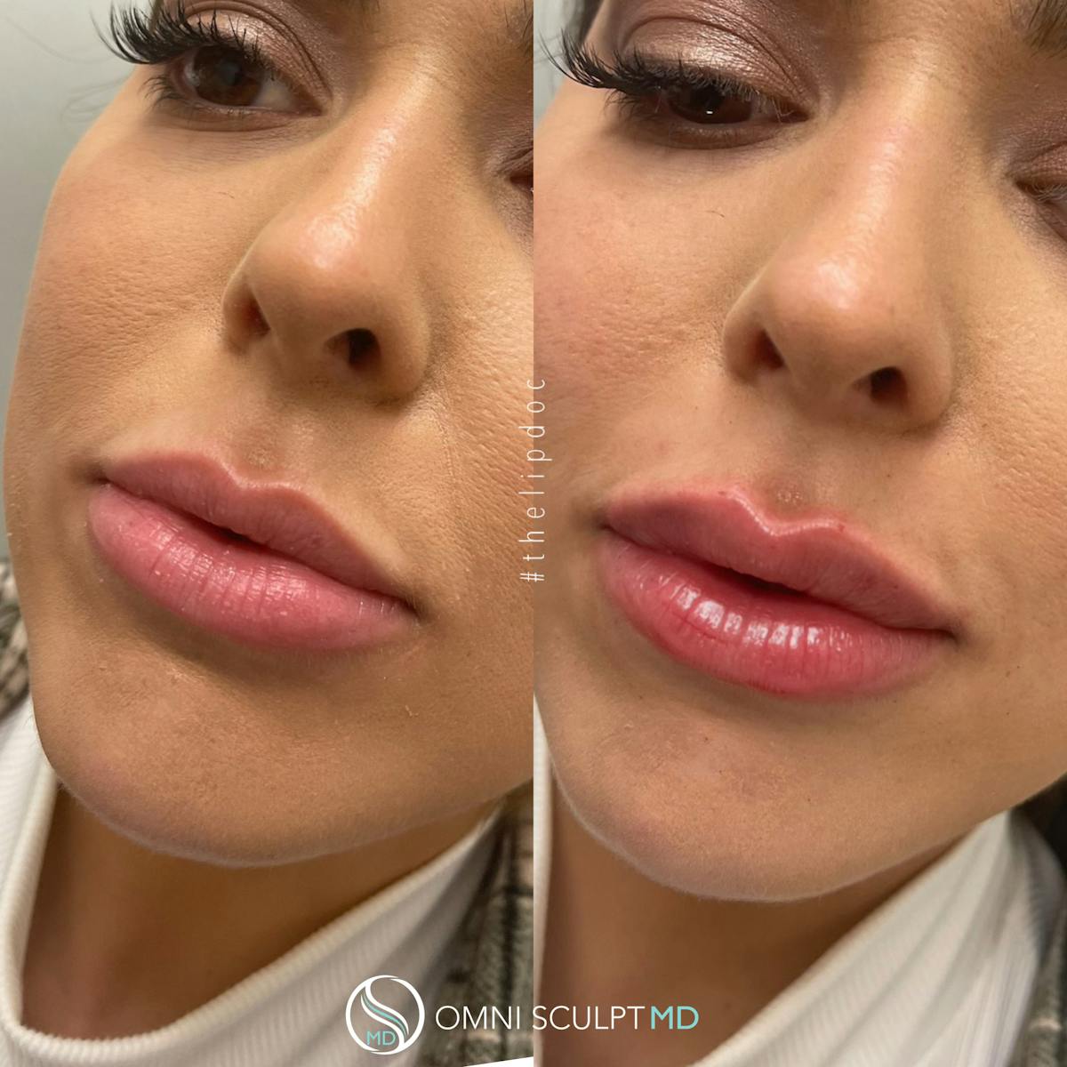 Lips Before & After Gallery - Patient 513655 - Image 2