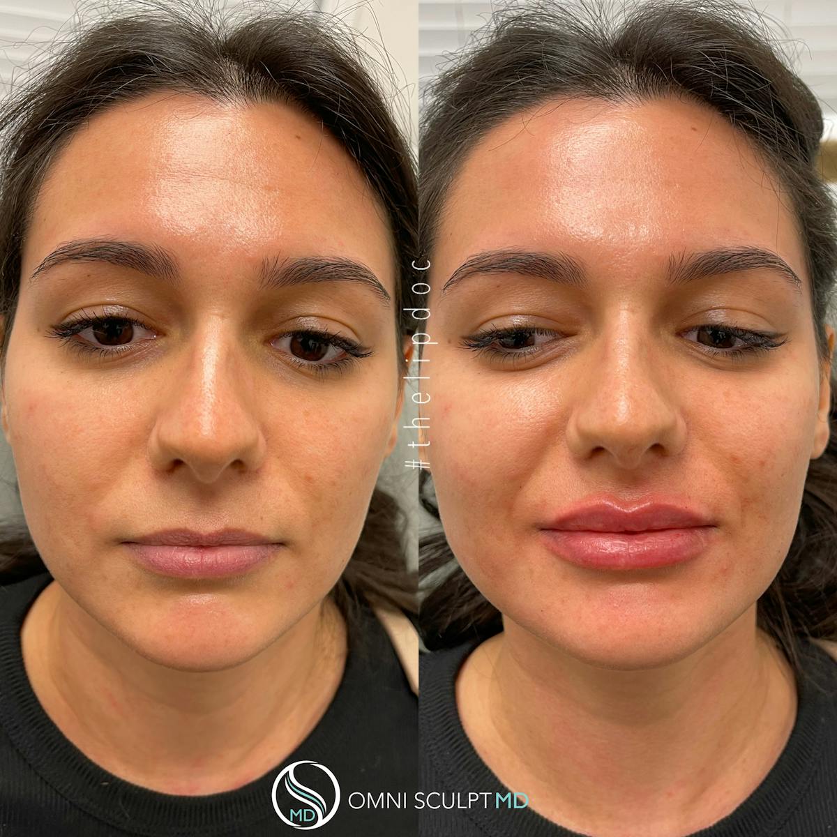 Lips Before & After Gallery - Patient 183456 - Image 1