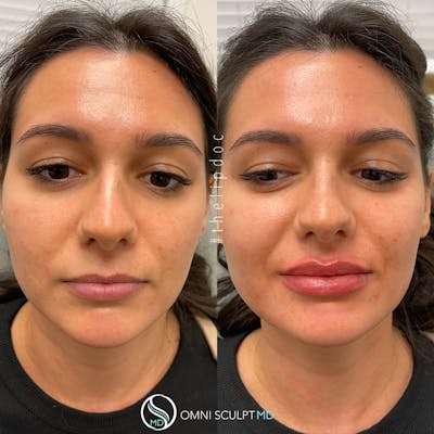 Lips Before & After Gallery - Patient 183456 - Image 1