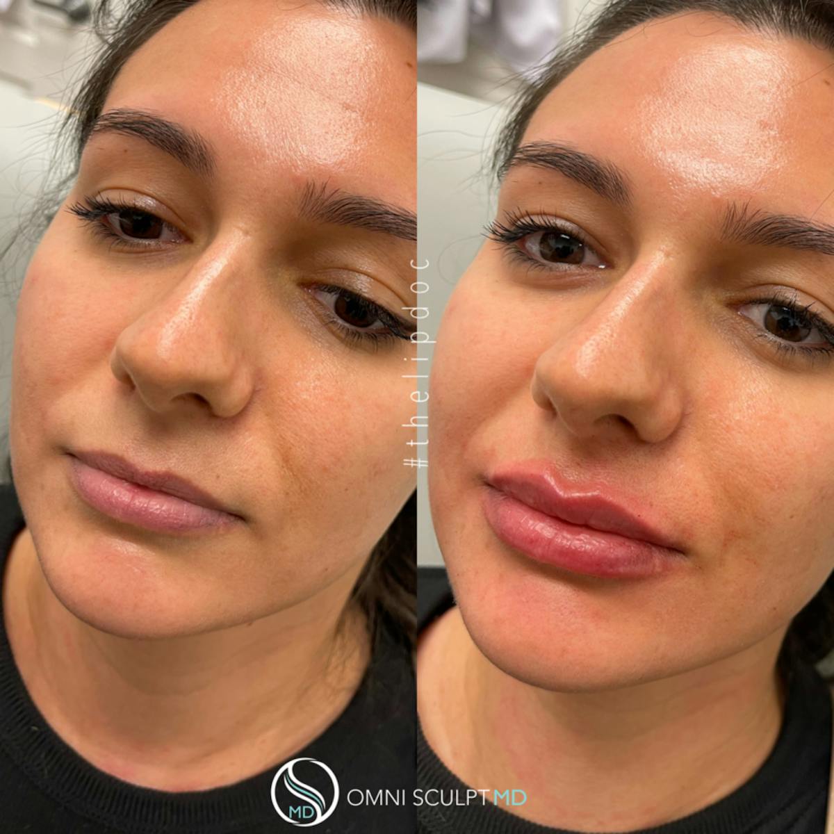 Lips Before & After Gallery - Patient 183456 - Image 2
