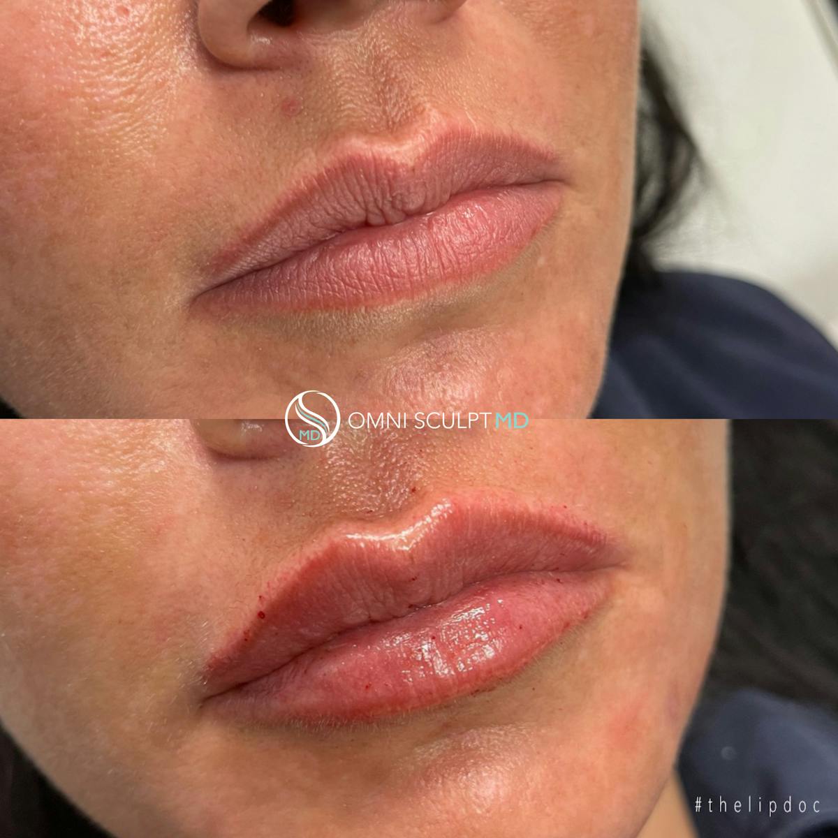 Lips Before & After Gallery - Patient 284597 - Image 1