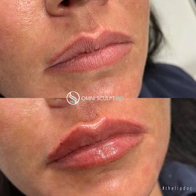 Lips Before & After Gallery - Patient 284597 - Image 1