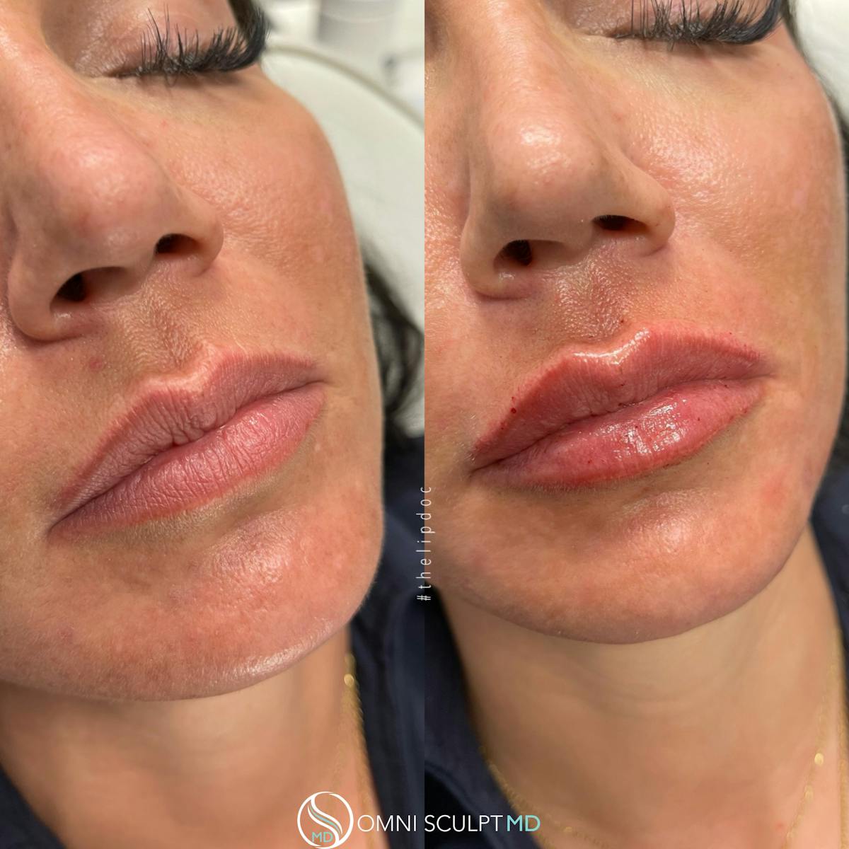 Lips Before & After Gallery - Patient 284597 - Image 2