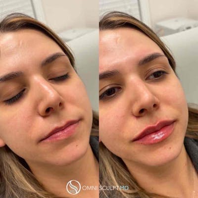 Lips Before & After Gallery - Patient 469248 - Image 1