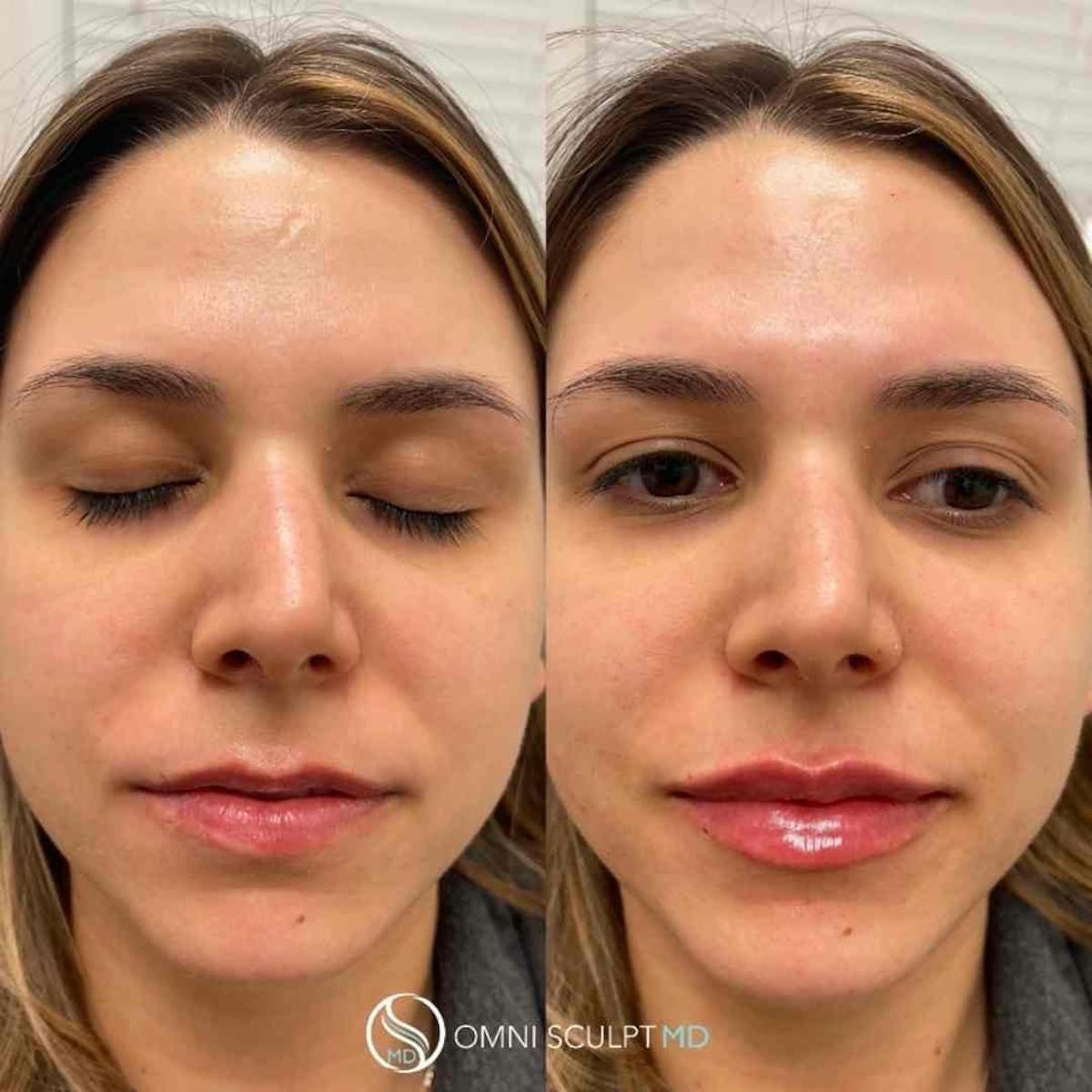Lips Before & After Gallery - Patient 469248 - Image 2