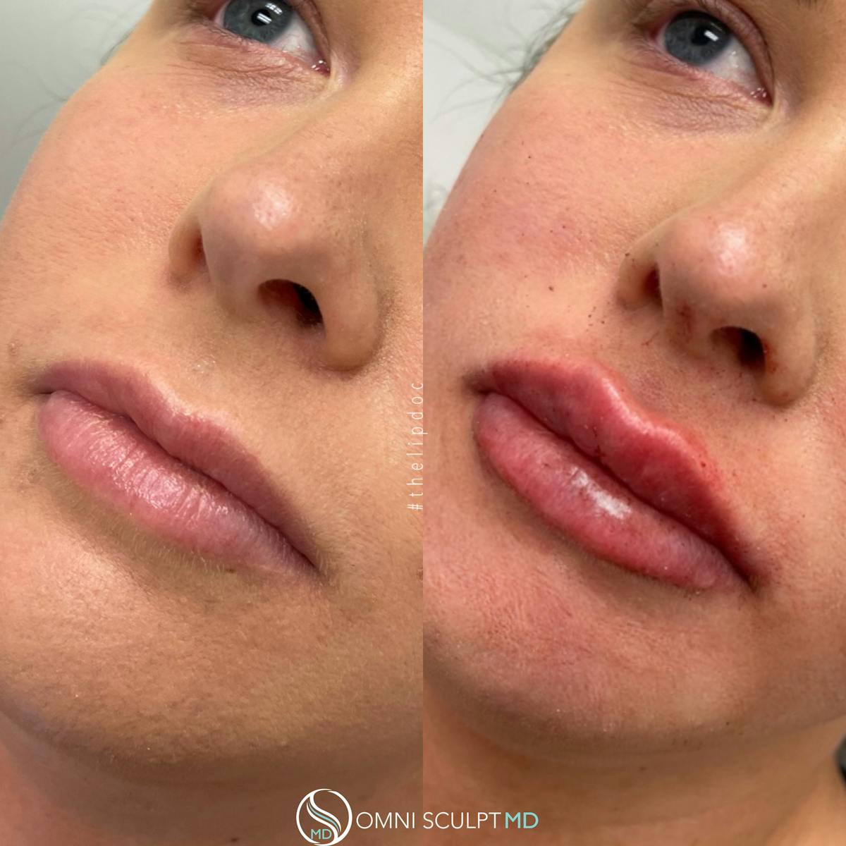 Lips Before & After Gallery - Patient 403431 - Image 1