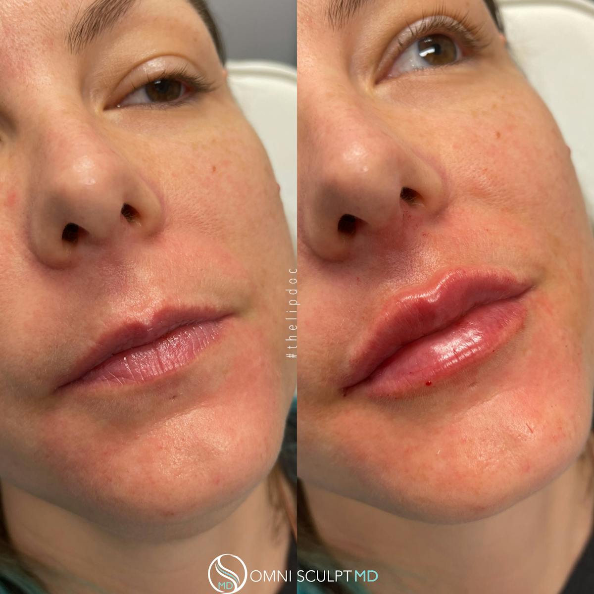 Lips Before & After Gallery - Patient 403431 - Image 2