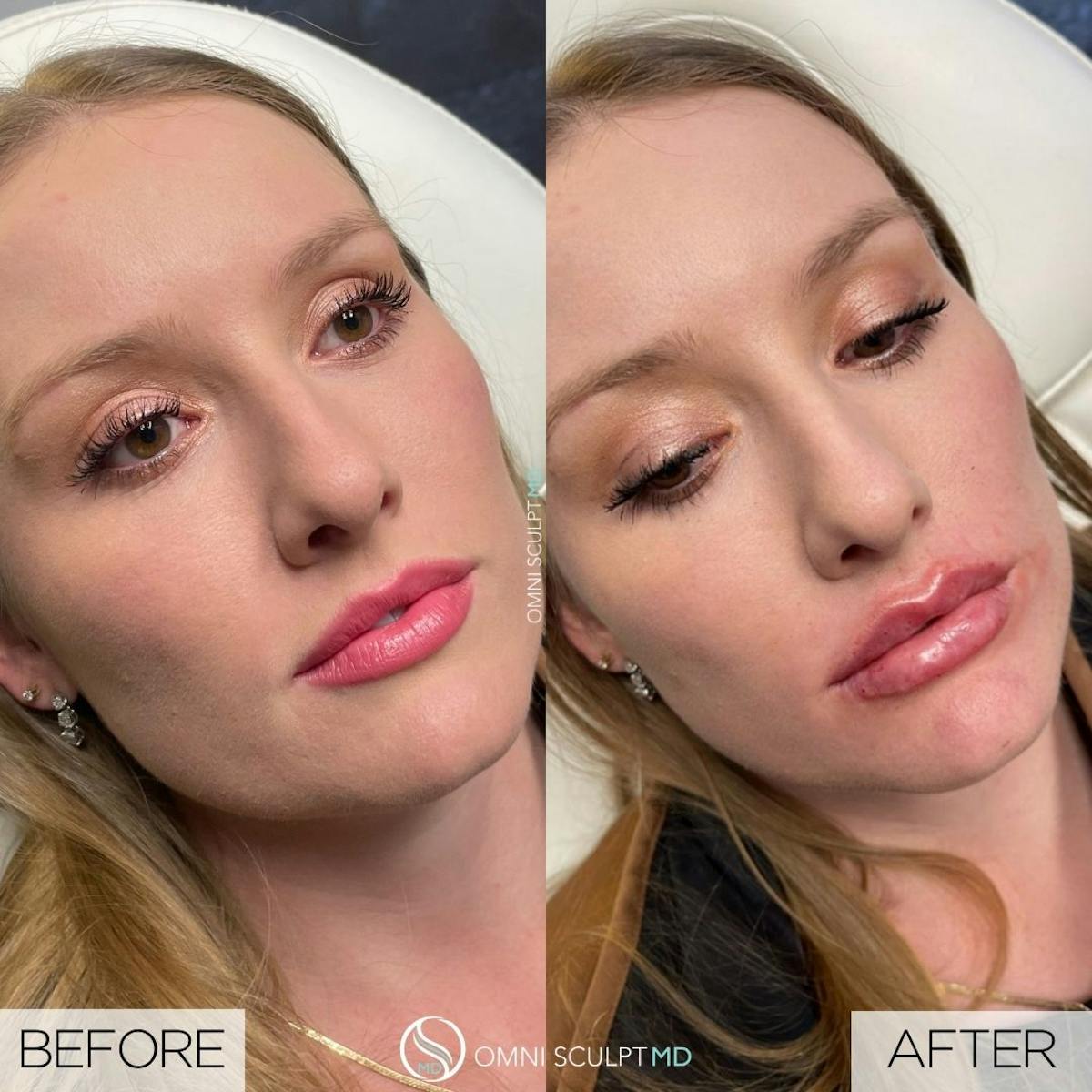 Lips Before & After Gallery - Patient 208641 - Image 1