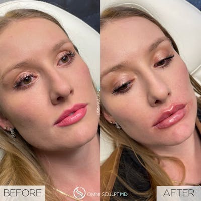 Lips Before & After Gallery - Patient 208641 - Image 1