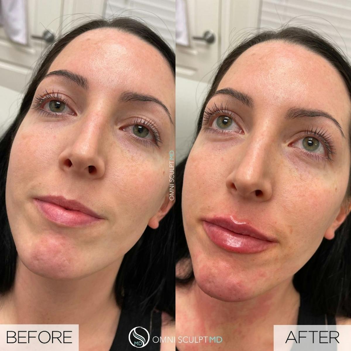 Lips Before & After Gallery - Patient 137695 - Image 1